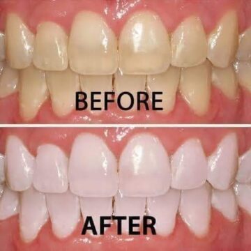 من أول استعمال 6 خلطات طبيعية لتبييض الأسنان وإزالة الجير لن تصدقي النتيجة