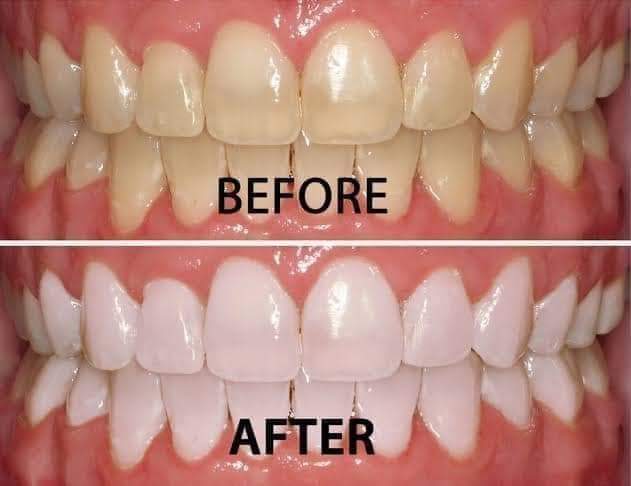 من أول استعمال 6 خلطات طبيعية لتبييض الأسنان وإزالة الجير لن تصدقي النتيجة